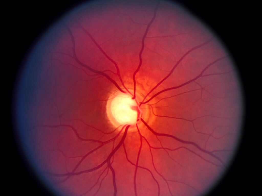 Patologie del nervo ottico - Escavazione papillare in paziente affetto da glaucoma